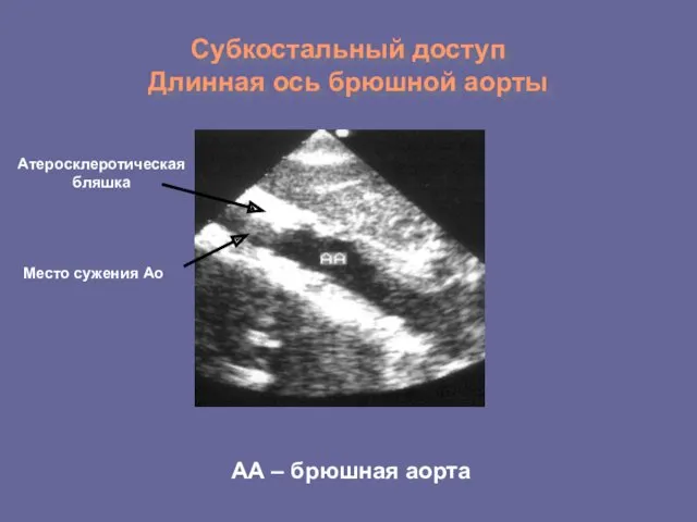 Субкостальный доступ Длинная ось брюшной аорты АА – брюшная аорта Атеросклеротическая бляшка Место сужения Ао