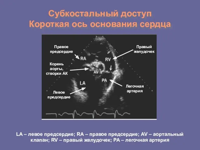 Субкостальный доступ Короткая ось основания сердца LA – левое предсердие;