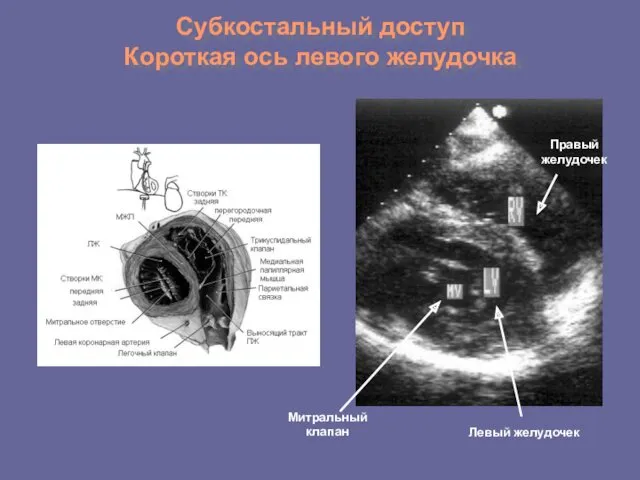 Субкостальный доступ Короткая ось левого желудочка Правый желудочек Митральный клапан Левый желудочек