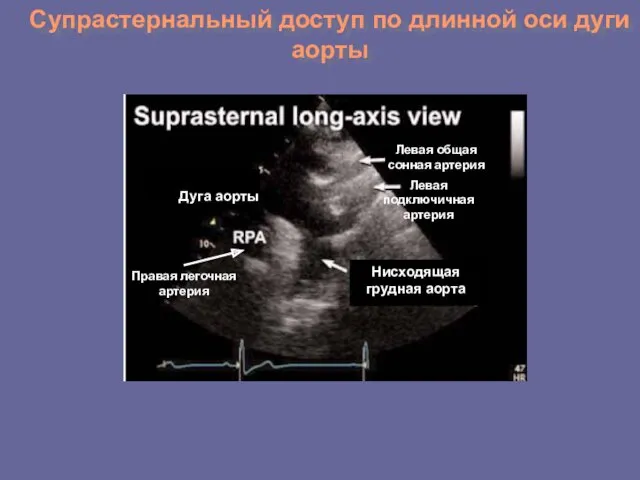 Супрастернальный доступ по длинной оси дуги аорты Левая общая сонная
