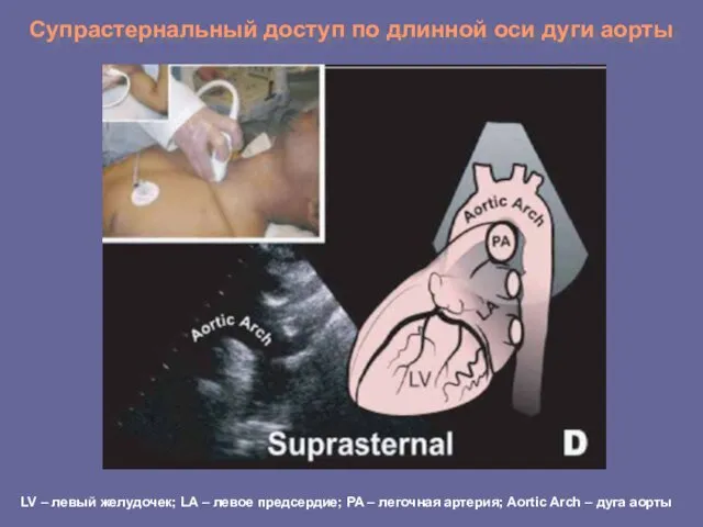 Супрастернальный доступ по длинной оси дуги аорты LV – левый