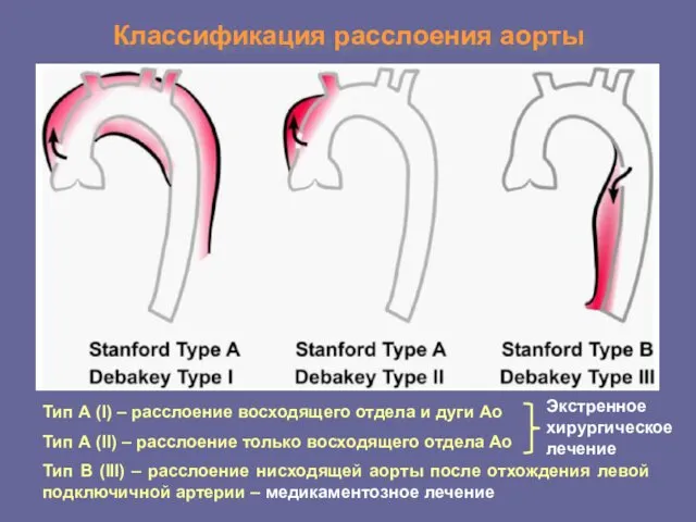 Классификация расслоения аорты Тип А (I) – расслоение восходящего отдела