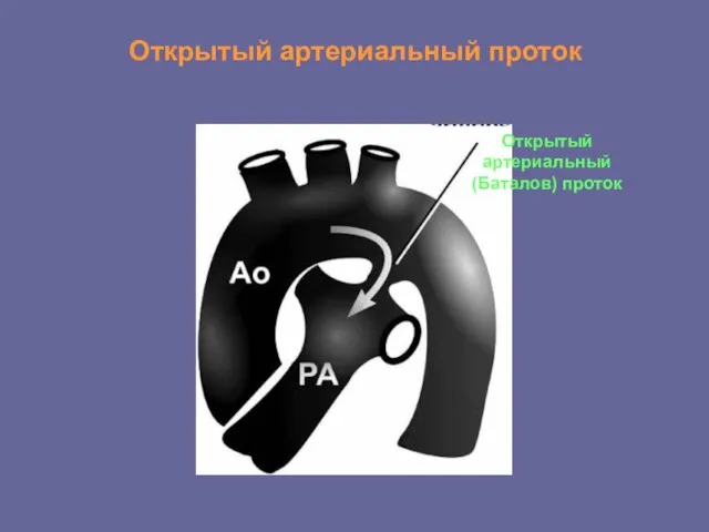 Открытый артериальный проток Открытый артериальный (Баталов) проток