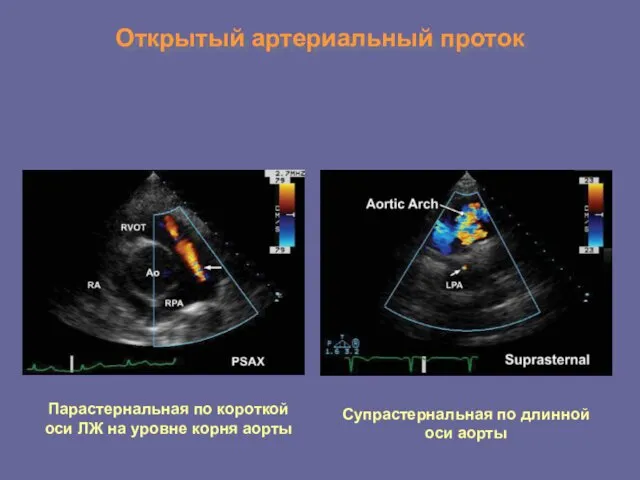 Открытый артериальный проток Парастернальная по короткой оси ЛЖ на уровне