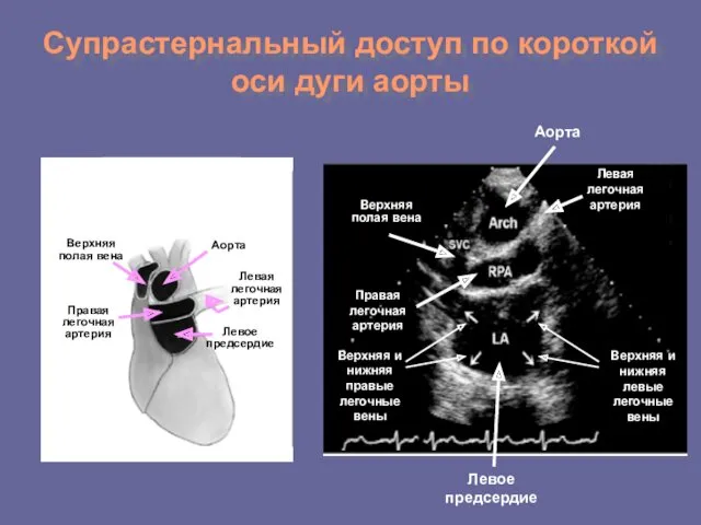 Супрастернальный доступ по короткой оси дуги аорты Аорта Верхняя полая