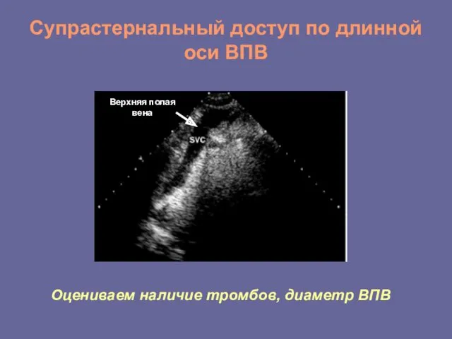 Супрастернальный доступ по длинной оси ВПВ Верхняя полая вена Оцениваем наличие тромбов, диаметр ВПВ