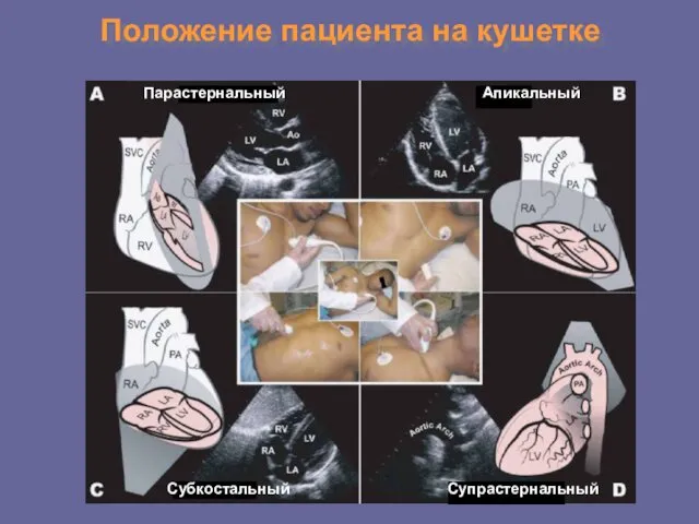 Положение пациента на кушетке Парастернальный Апикальный Субкостальный Супрастернальный