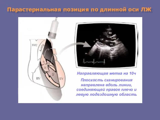 Парастернальная позиция по длинной оси ЛЖ Направляющая метка на 10ч