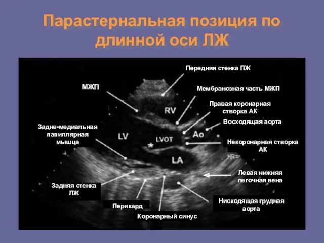 Парастернальная позиция по длинной оси ЛЖ МЖП Задне-медиальная папиллярная мышца