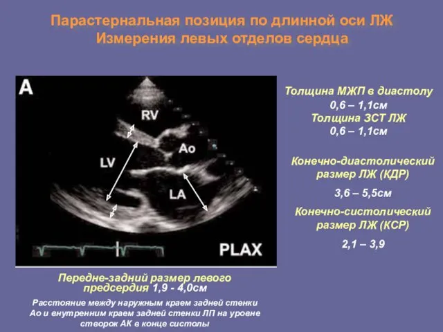 Парастернальная позиция по длинной оси ЛЖ Измерения левых отделов сердца