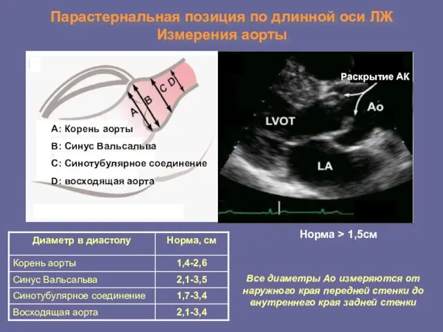 Парастернальная позиция по длинной оси ЛЖ Измерения аорты А: Корень