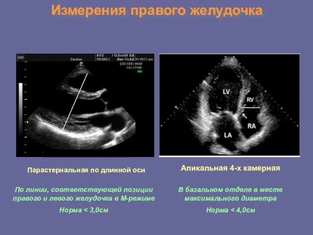 Измерения правого желудочка Парастернальная по длинной оси Апикальная 4-х камерная