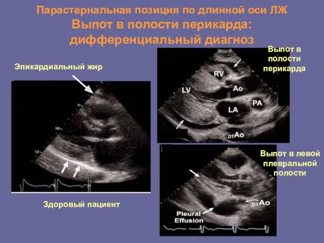 Парастернальная позиция по длинной оси ЛЖ Выпот в полости перикарда: