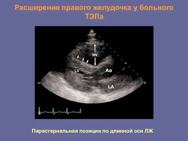 Расширение правого желудочка у больного ТЭЛа Парастернальная позиция по длинной оси ЛЖ