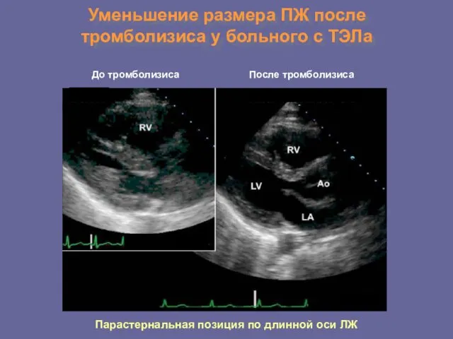 Уменьшение размера ПЖ после тромболизиса у больного с ТЭЛа До