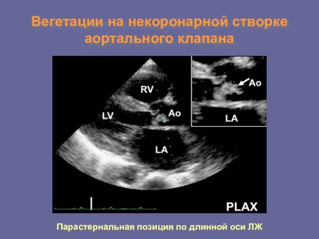 Вегетации на некоронарной створке аортального клапана Парастернальная позиция по длинной оси ЛЖ