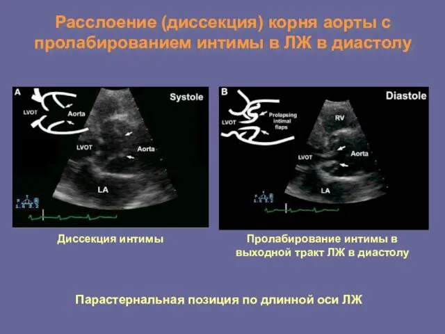 Расслоение (диссекция) корня аорты с пролабированием интимы в ЛЖ в