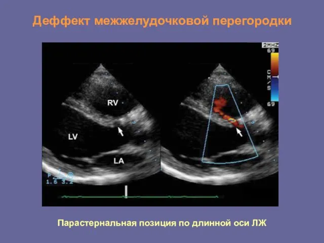 Деффект межжелудочковой перегородки Парастернальная позиция по длинной оси ЛЖ