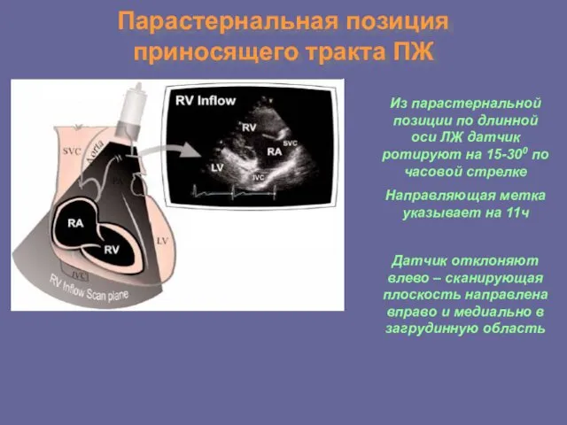 Парастернальная позиция приносящего тракта ПЖ Из парастернальной позиции по длинной
