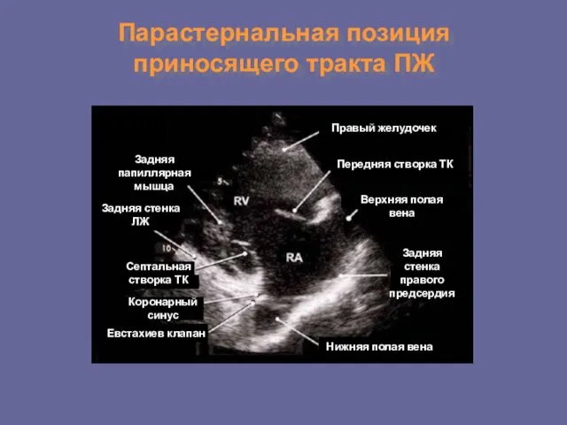 Парастернальная позиция приносящего тракта ПЖ Задняя папиллярная мышца Задняя стенка