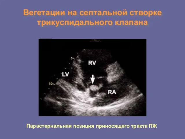 Вегетации на септальной створке трикуспидального клапана Парастернальная позиция приносящего тракта ПЖ