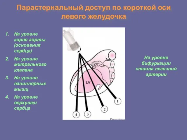 Парастернальный доступ по короткой оси левого желудочка На уровне корня