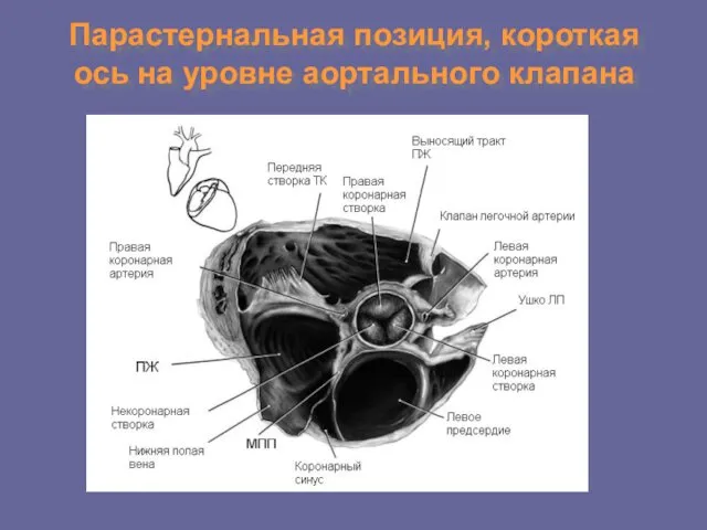 Парастернальная позиция, короткая ось на уровне аортального клапана