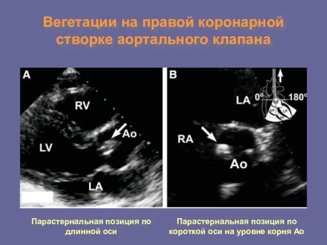 Вегетации на правой коронарной створке аортального клапана Парастернальная позиция по