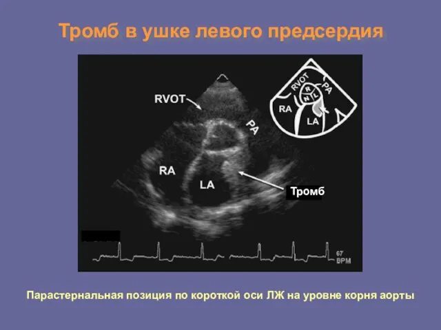 Тромб в ушке левого предсердия Парастернальная позиция по короткой оси ЛЖ на уровне корня аорты Тромб