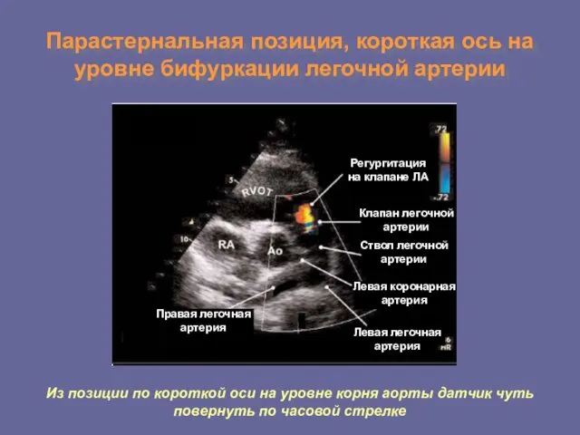 Парастернальная позиция, короткая ось на уровне бифуркации легочной артерии Правая