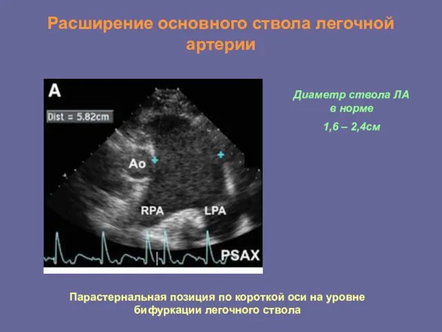 Расширение основного ствола легочной артерии Парастернальная позиция по короткой оси