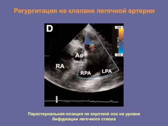 Регургитация на клапане легочной артерии Парастернальная позиция по короткой оси на уровне бифуркации легочного ствола