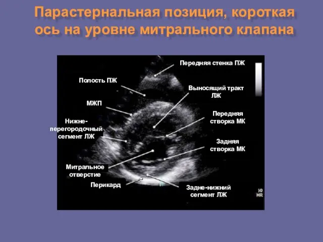 Парастернальная позиция, короткая ось на уровне митрального клапана Перикард Митральное