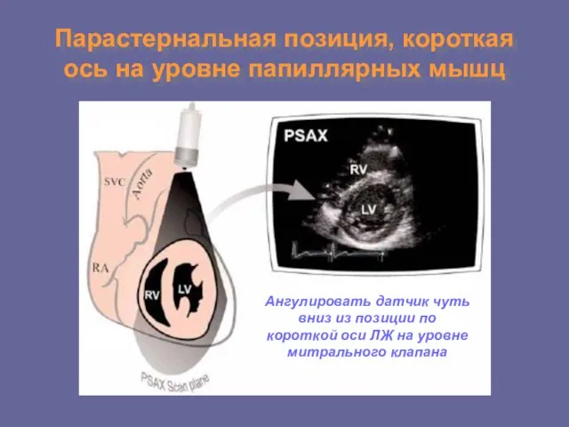 Парастернальная позиция, короткая ось на уровне папиллярных мышц Ангулировать датчик