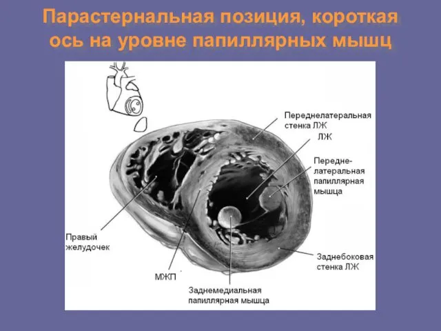 Парастернальная позиция, короткая ось на уровне папиллярных мышц