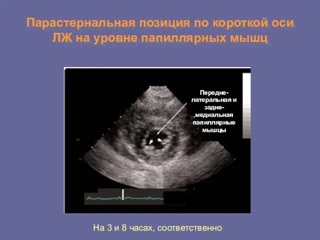 Парастернальная позиция по короткой оси ЛЖ на уровне папиллярных мышц