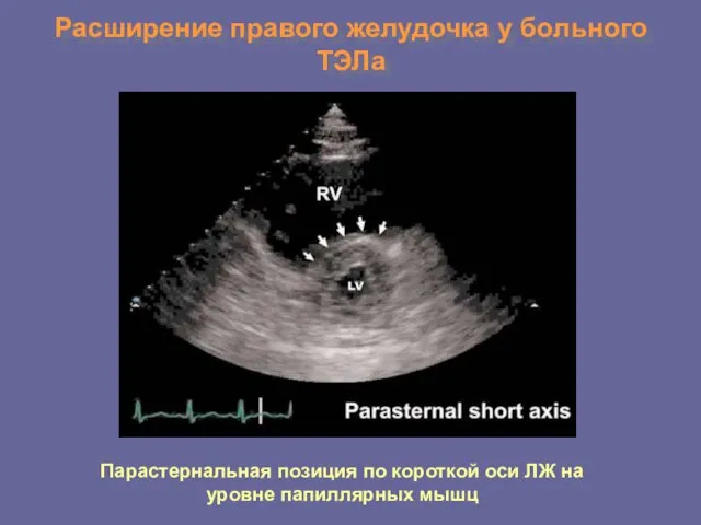 Расширение правого желудочка у больного ТЭЛа Парастернальная позиция по короткой оси ЛЖ на уровне папиллярных мышц