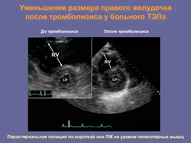 Уменьшение размера правого желудочка после тромболизиса у больного ТЭЛа До