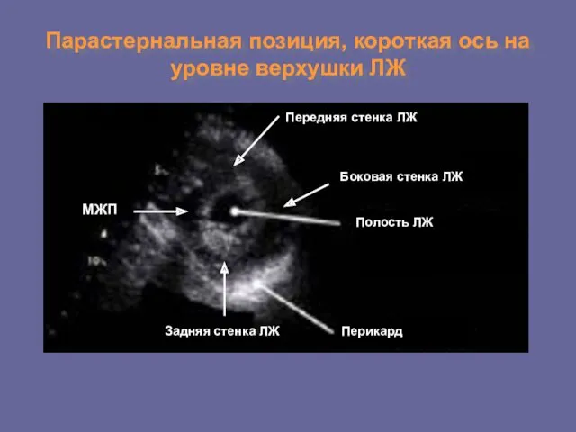 Парастернальная позиция, короткая ось на уровне верхушки ЛЖ Перикард Полость