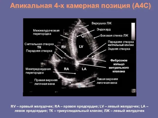 Апикальная 4-х камерная позиция (А4С) Верхушка ЛЖ Эндокард Боковая стенка