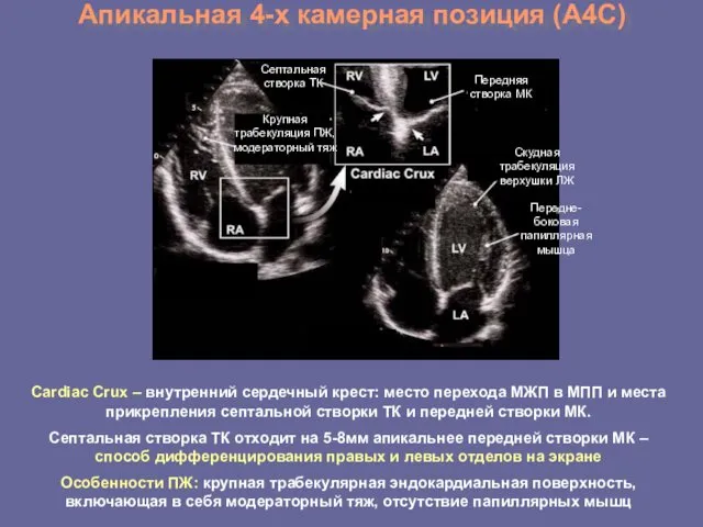 Апикальная 4-х камерная позиция (А4С) Cardiac Crux – внутренний сердечный
