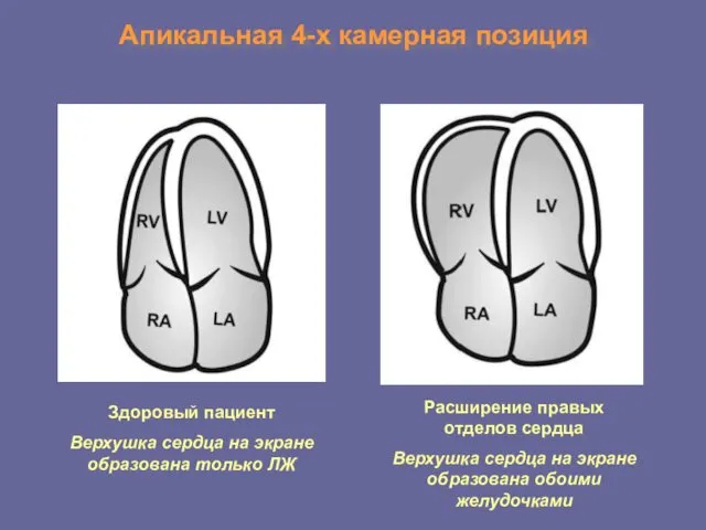 Апикальная 4-х камерная позиция Здоровый пациент Верхушка сердца на экране