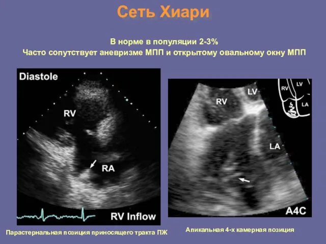 Сеть Хиари В норме в популяции 2-3% Часто сопутствует аневризме