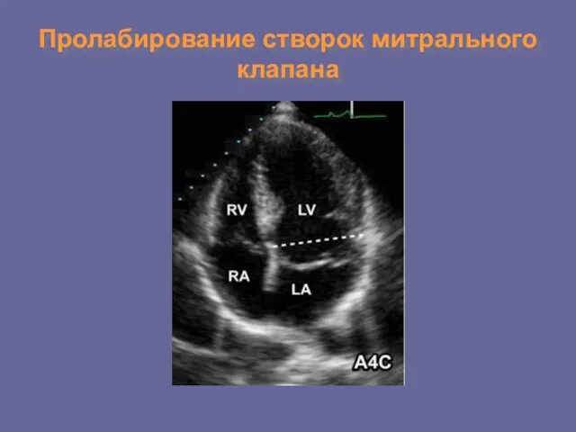 Пролабирование створок митрального клапана