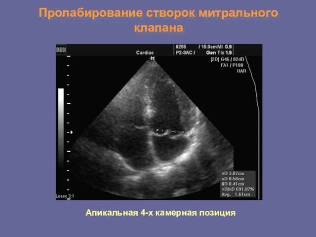 Пролабирование створок митрального клапана Апикальная 4-х камерная позиция