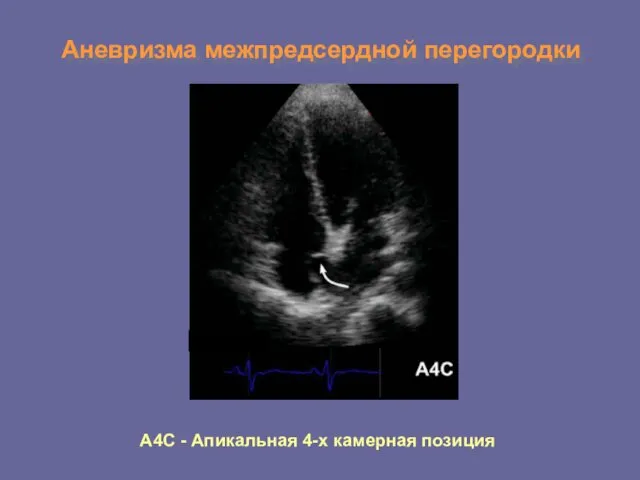 Аневризма межпредсердной перегородки А4С - Апикальная 4-х камерная позиция