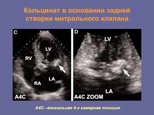 Кальцинат в основании задней створки митрального клапана А4С –апикальная 4-х камерная позиция