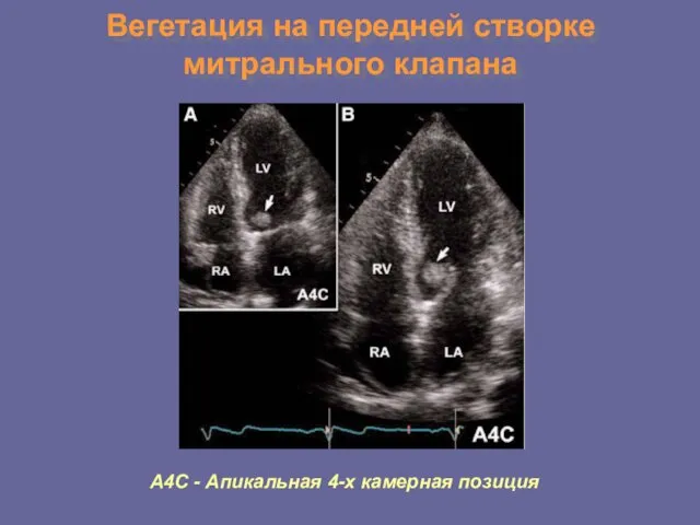 Вегетация на передней створке митрального клапана А4С - Апикальная 4-х камерная позиция