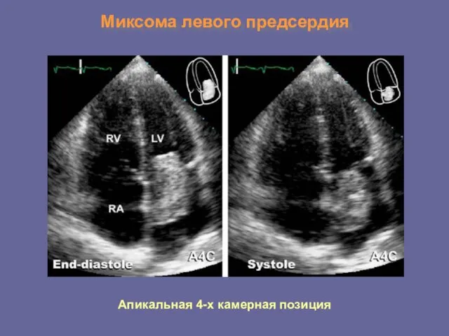 Миксома левого предсердия Апикальная 4-х камерная позиция