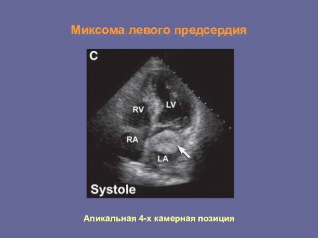 Миксома левого предсердия Апикальная 4-х камерная позиция